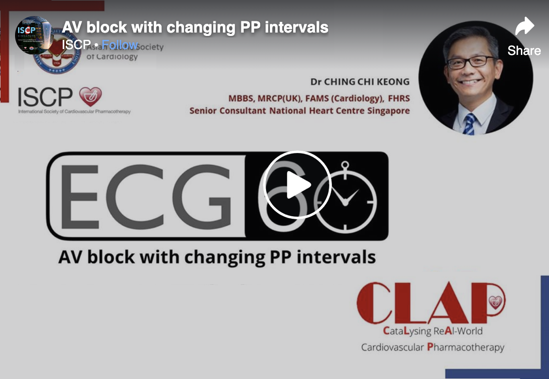 AV Block with Changing PP Intervals